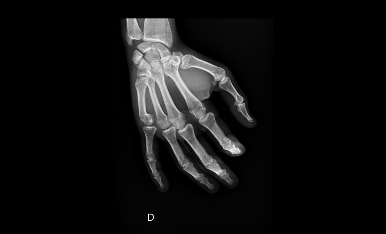 Radiographie de trois quarts de la main droite : fracture du col du 5e métacarpien, la tête de l'os est basculée vers la paume.