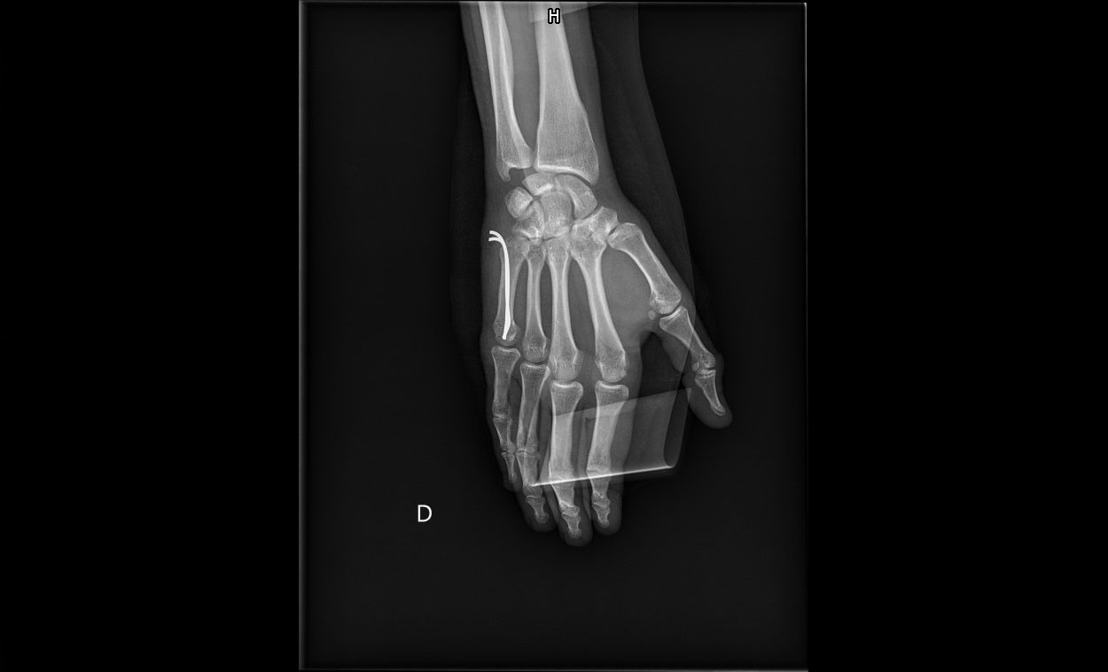 Radiographie de face de la main après embrochage : deux broches introduites à la base du 5e métacarpien, à extrémité recourbée, remontent dans l'os jusqu'à la tête.