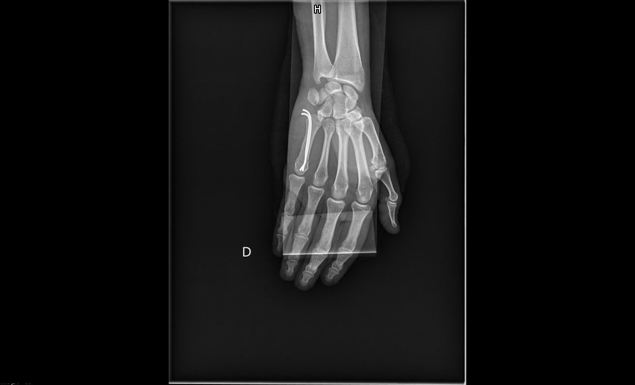 Radiographie de profil de la main après embrochage : les deux broches suivent l'intérieur du 5e métacarpien jusqu'à la tête, remise dans l'axe de l'os.