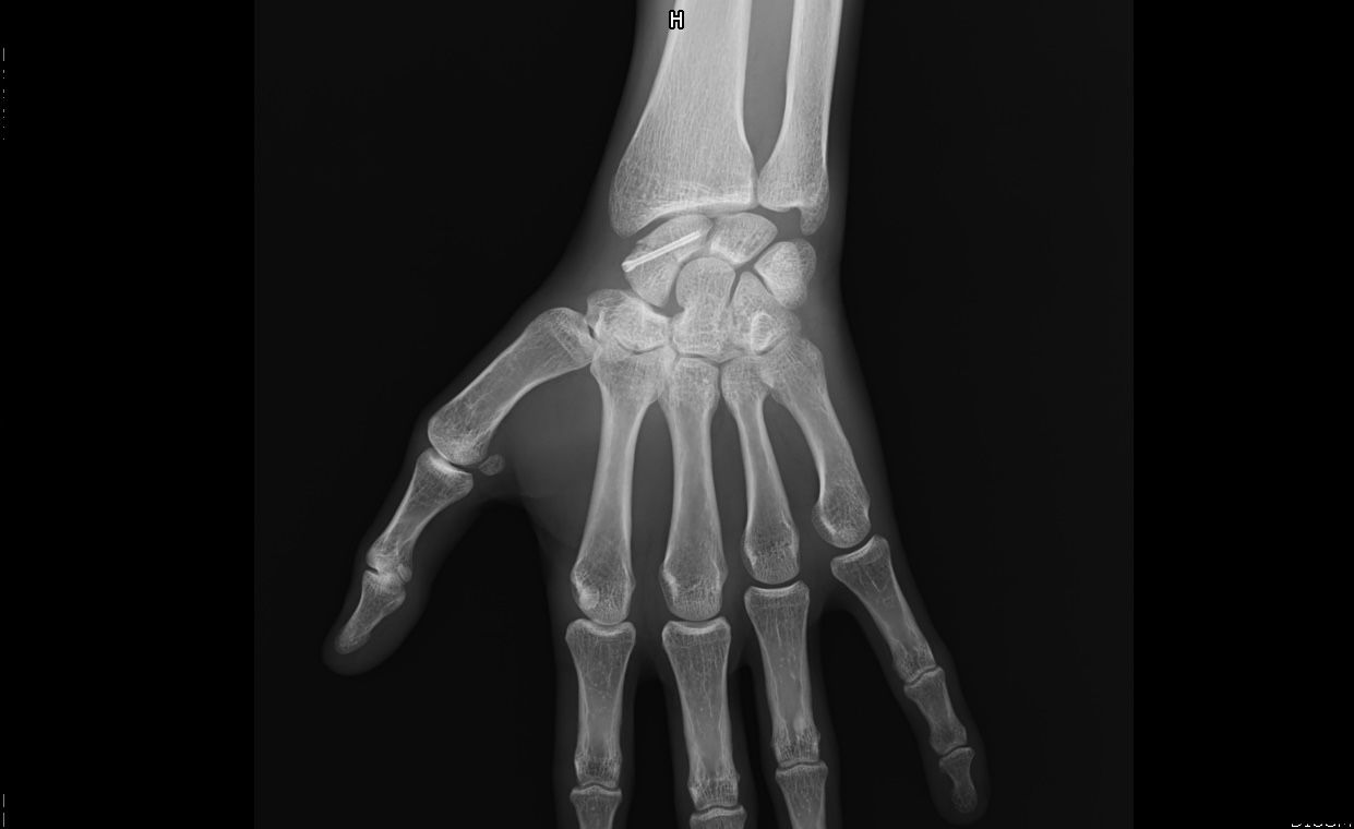 Radiographie de face du poignet après vissage : une vis sans tête traverse le scaphoïde dans sa longueur, à la base du pouce ; les autres os du carpe sont normaux.